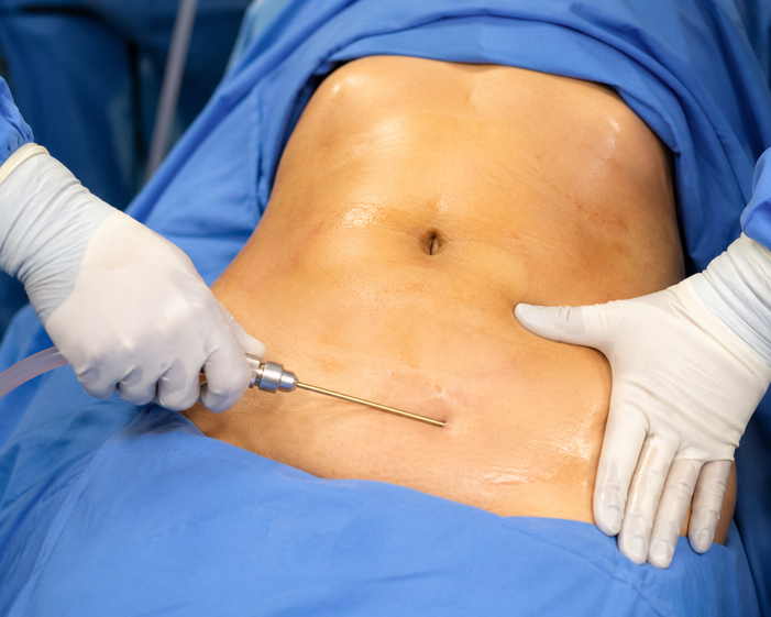 Surgeon consulting a patient about Abdomen Liposuction